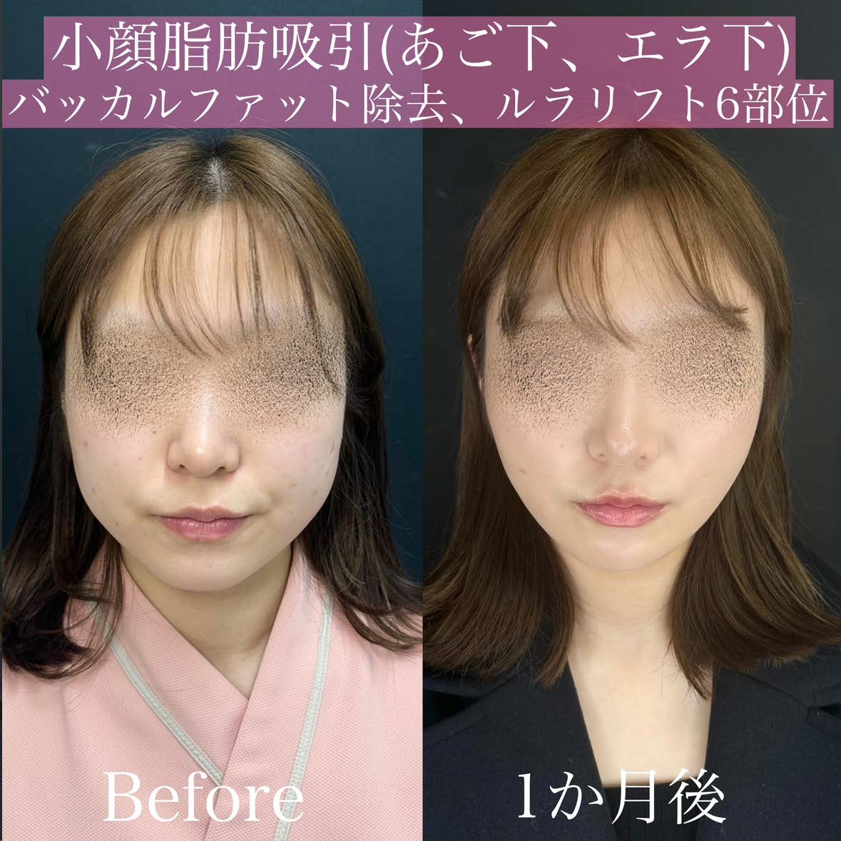 脂肪吸引の症例写真