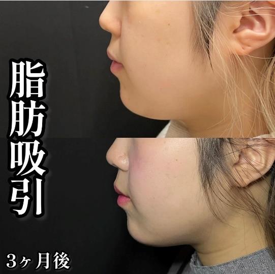 脂肪吸引の症例写真