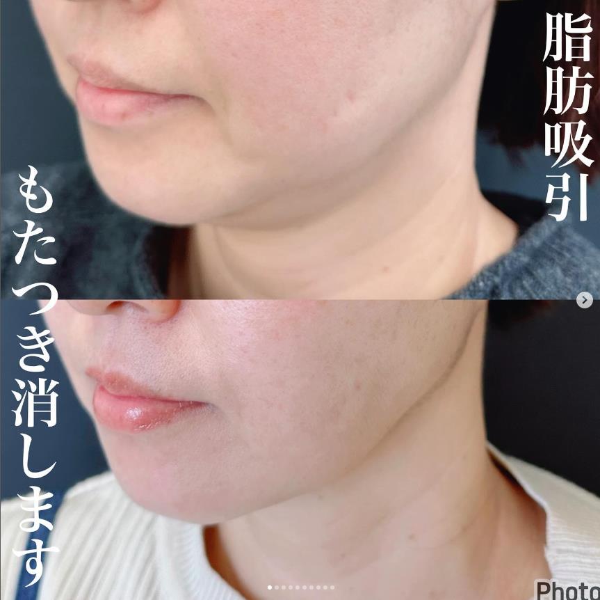 脂肪吸引の症例写真