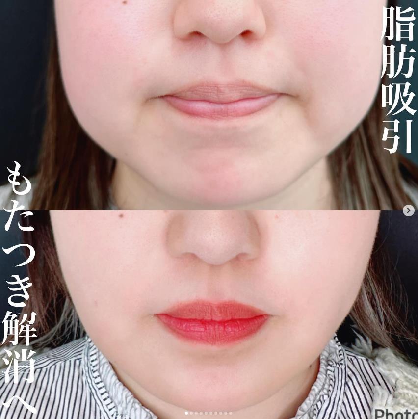 脂肪吸引の症例写真