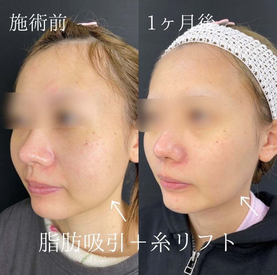 脂肪吸引の症例写真