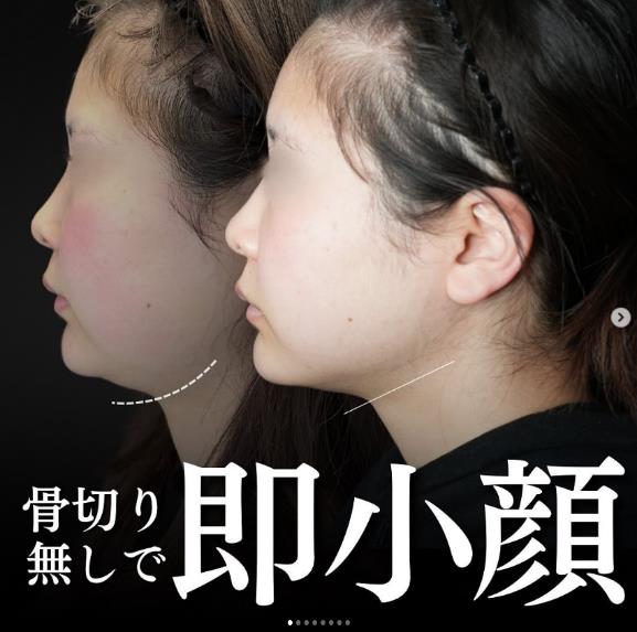 脂肪吸引の症例写真