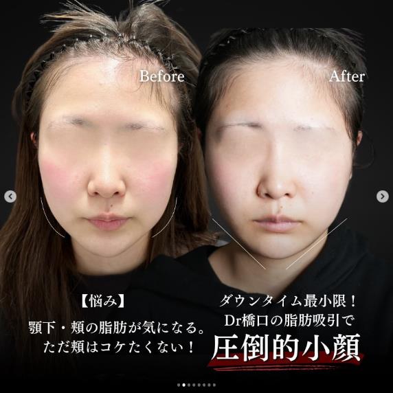 脂肪吸引の症例写真