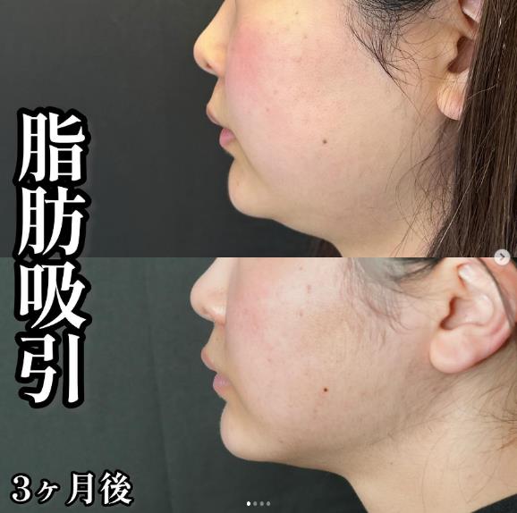 脂肪吸引の症例写真