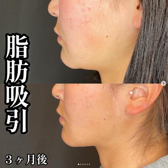 脂肪吸引の症例写真