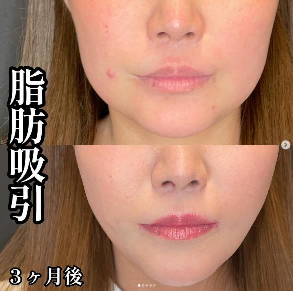 脂肪吸引の症例写真