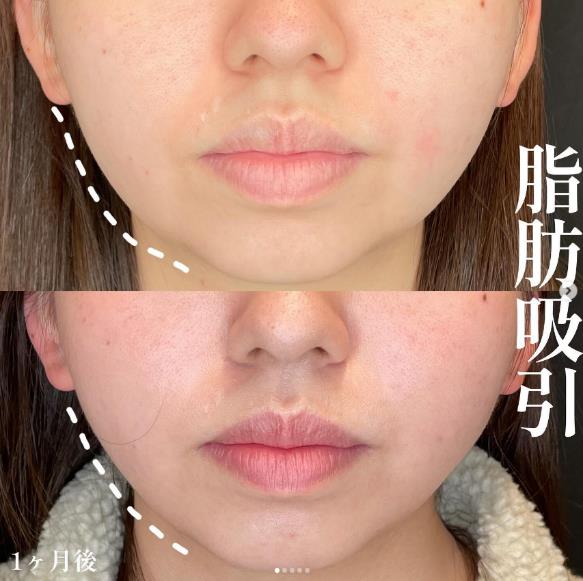 脂肪吸引の症例写真
