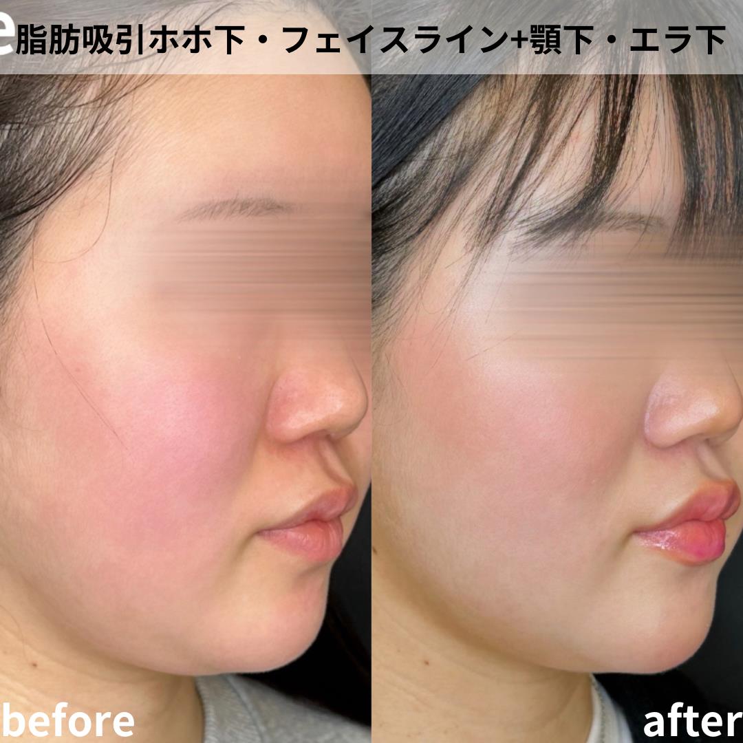 脂肪吸引の症例写真