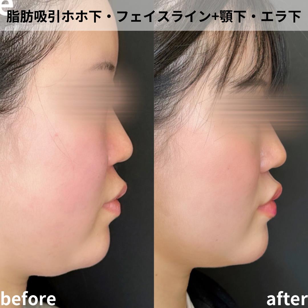 脂肪吸引の症例写真