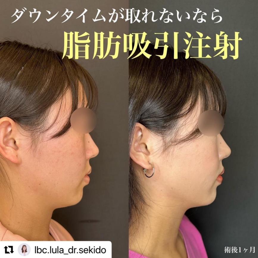 脂肪吸引の症例写真
