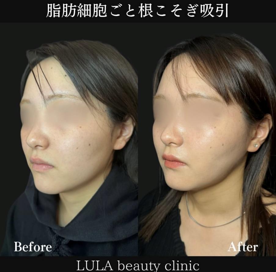 脂肪吸引の症例写真