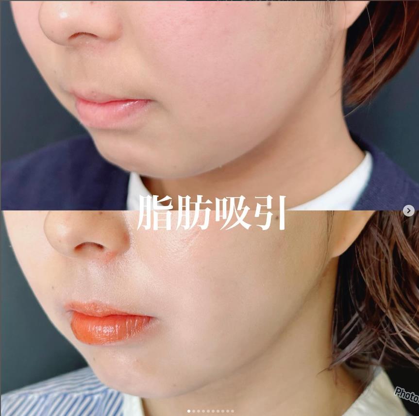 脂肪吸引の症例写真