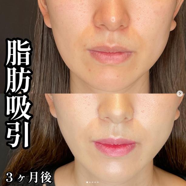 脂肪吸引の症例写真