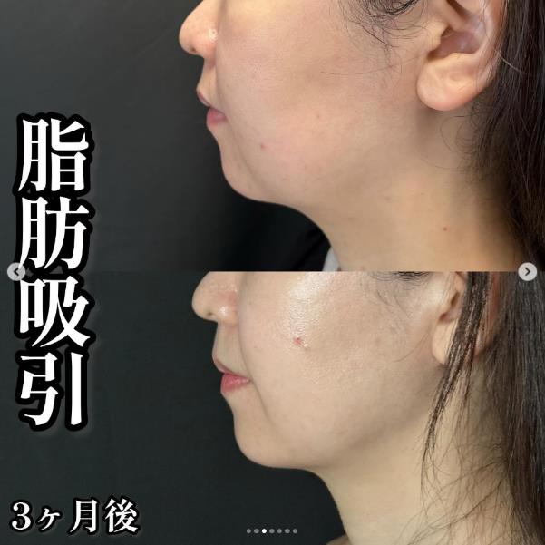 脂肪吸引の症例写真