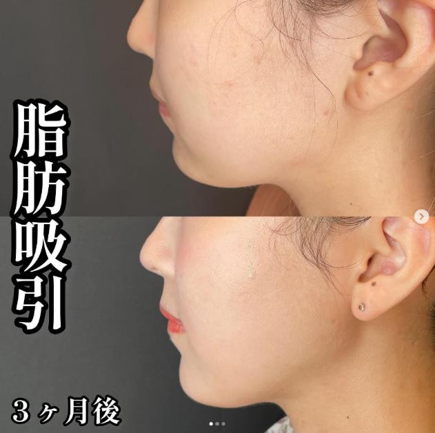 脂肪吸引の症例写真