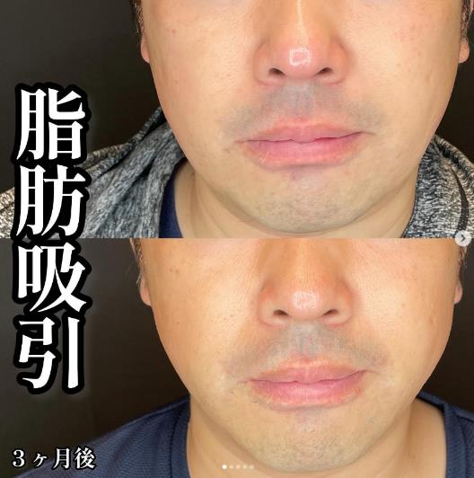 脂肪吸引の症例写真