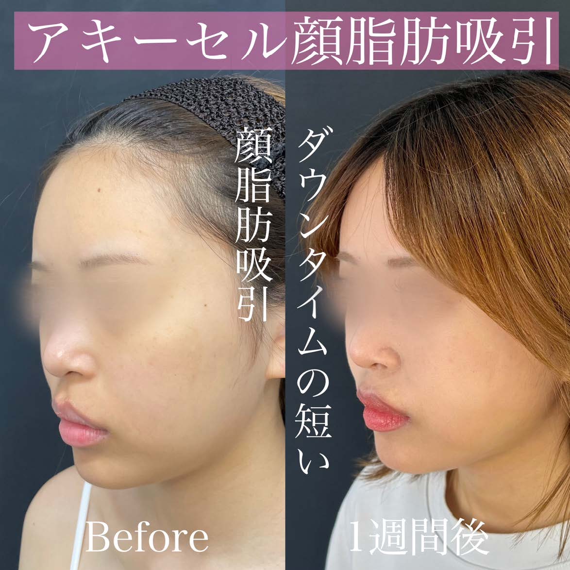 脂肪吸引の症例写真