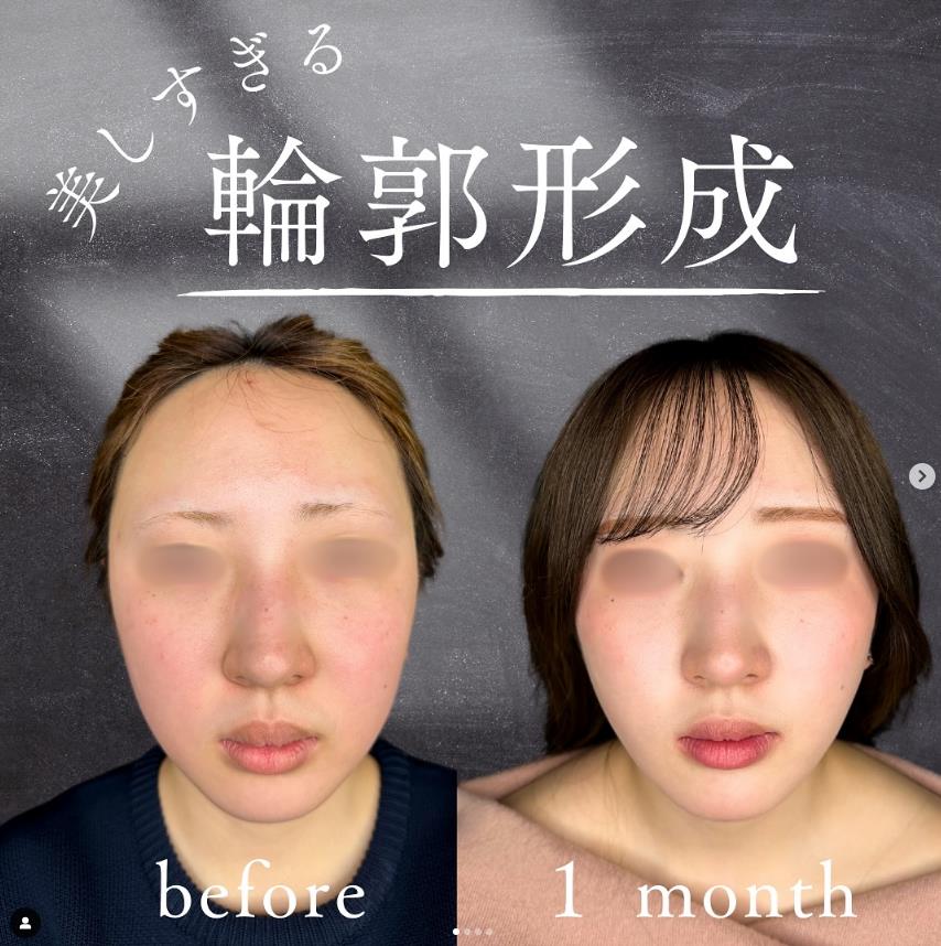 脂肪吸引の症例写真