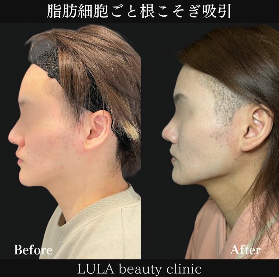 脂肪吸引の症例写真