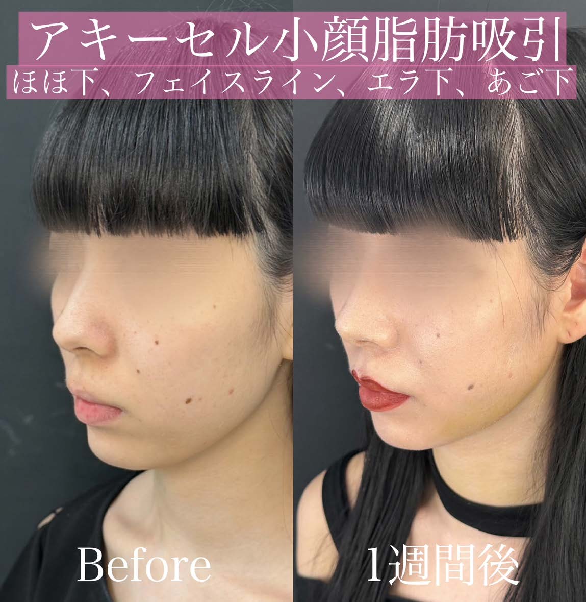 脂肪吸引の症例写真