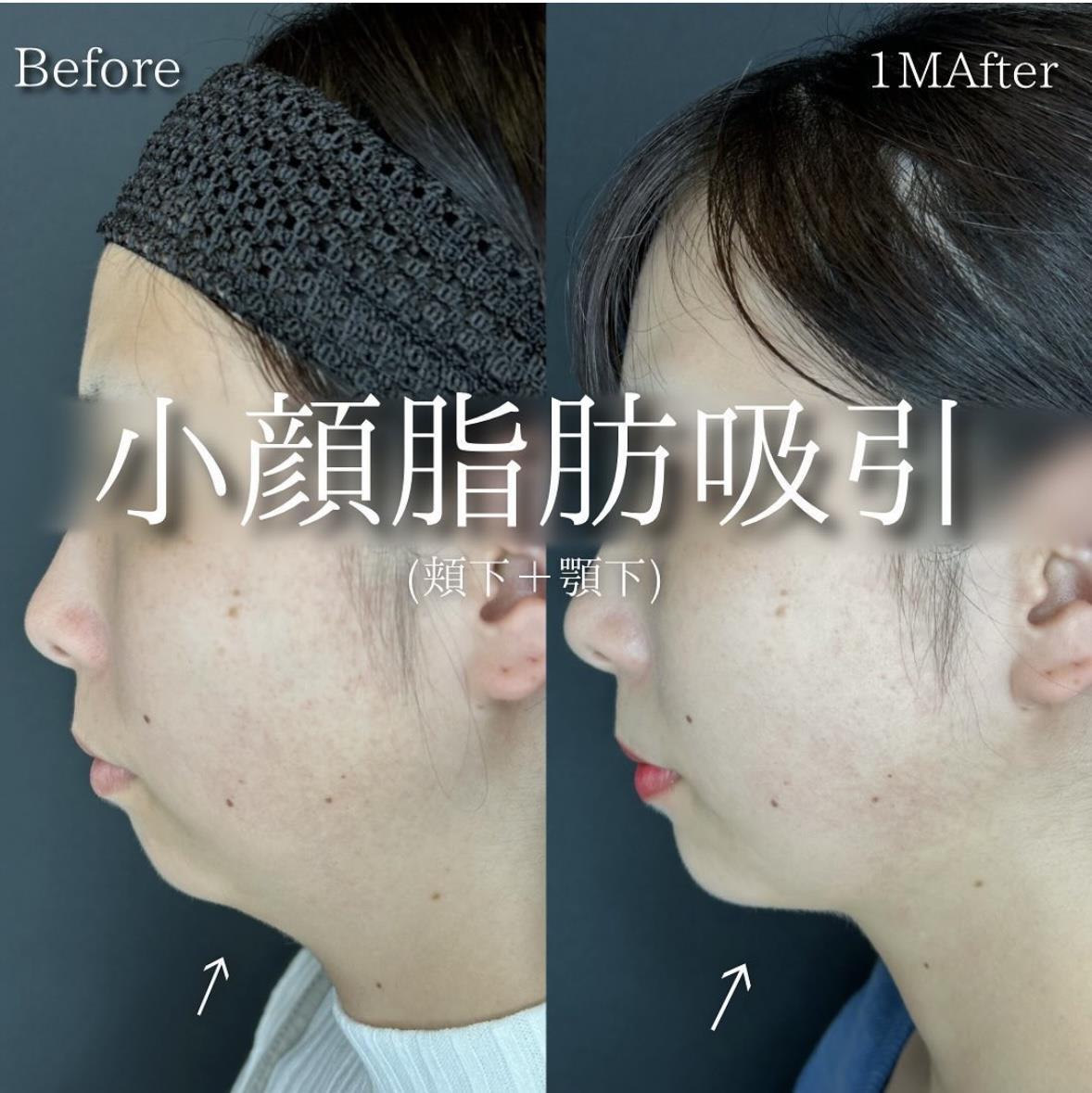 脂肪吸引の症例写真