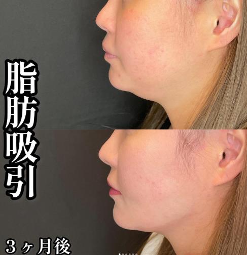 脂肪吸引の症例写真