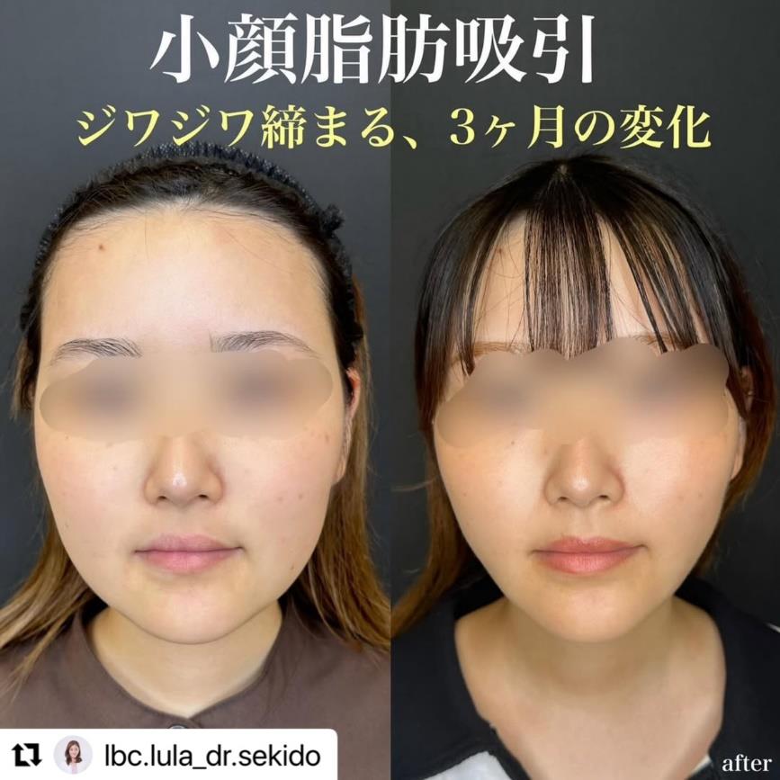 脂肪吸引の症例写真