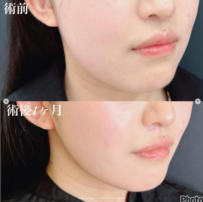 脂肪吸引の症例写真