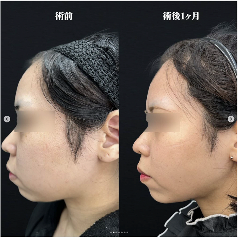 脂肪吸引の症例写真