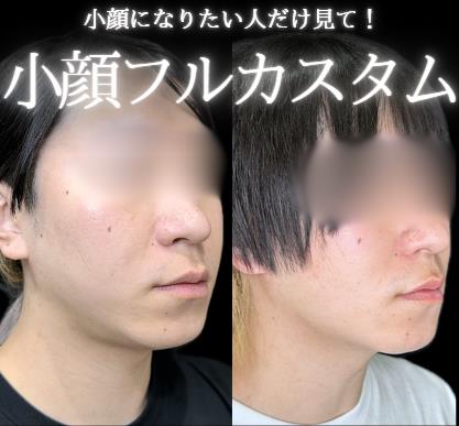 脂肪吸引の症例写真