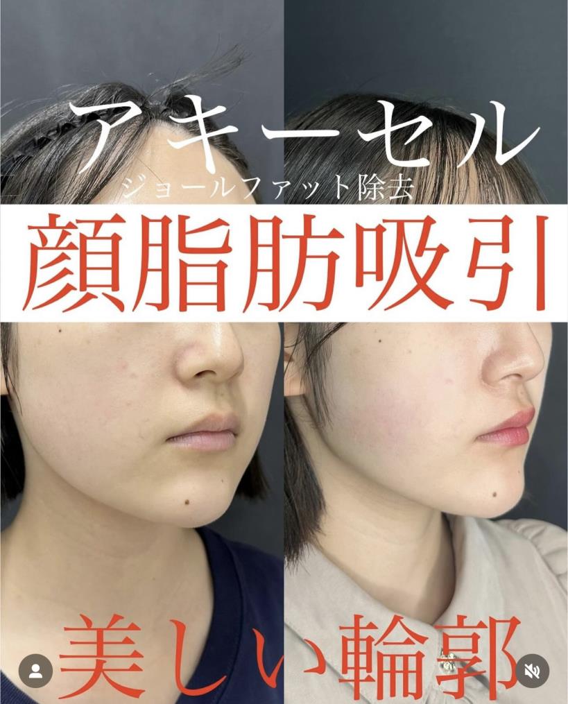 脂肪吸引の症例写真