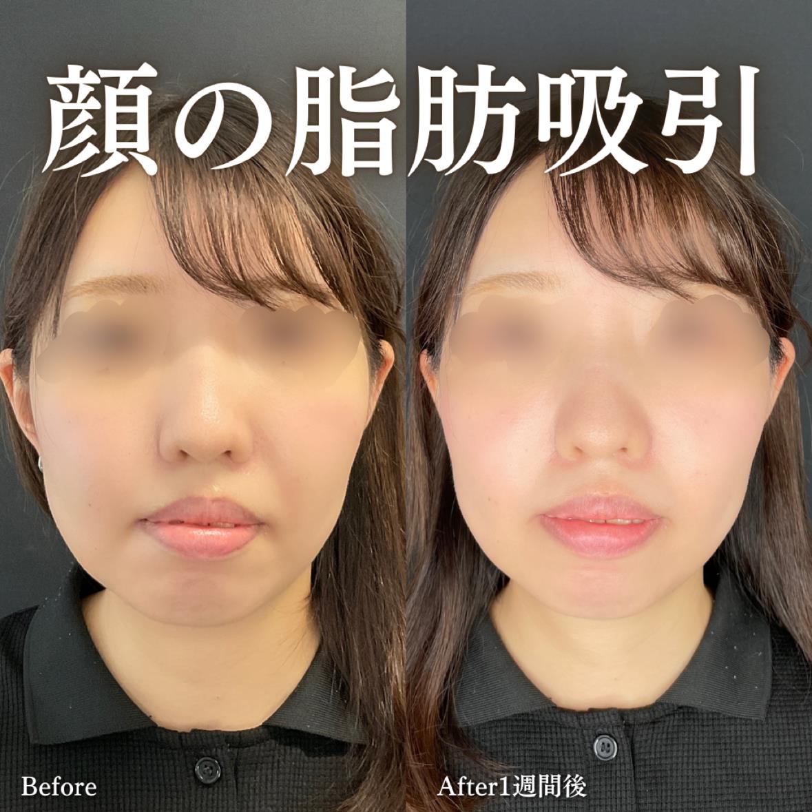 脂肪吸引の症例写真