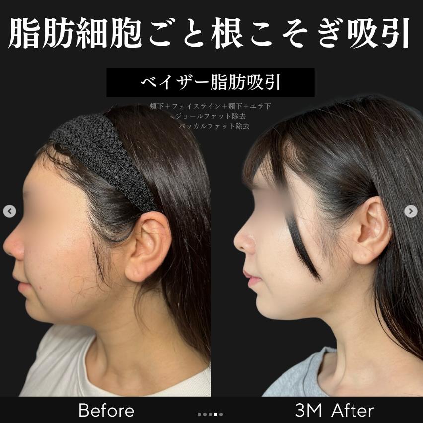 脂肪吸引の症例写真