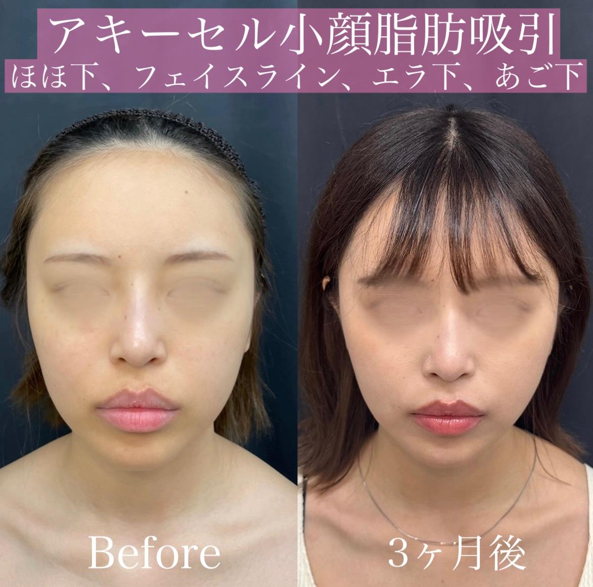 脂肪吸引の症例写真
