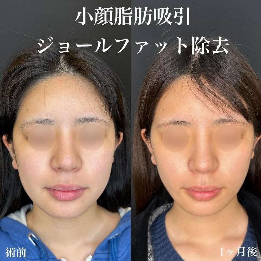 脂肪吸引の症例写真