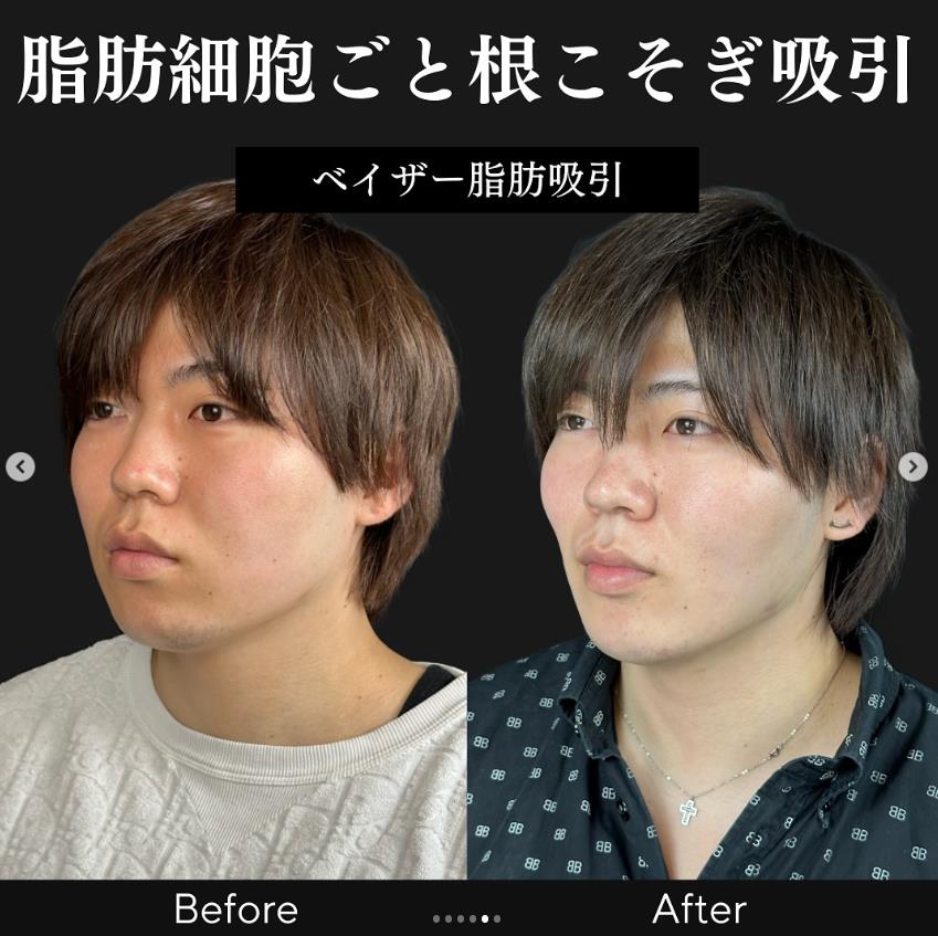 脂肪吸引の症例写真