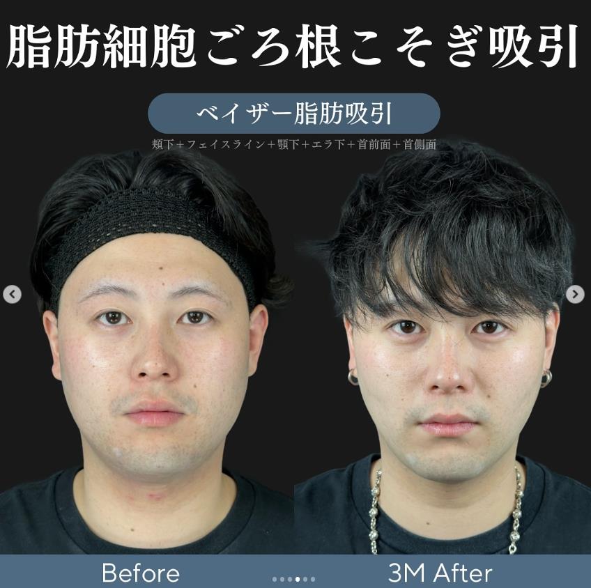 脂肪吸引の症例写真