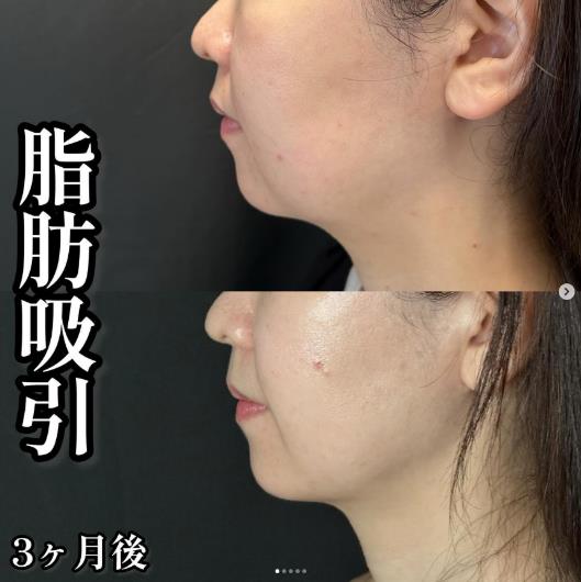 脂肪吸引の症例写真