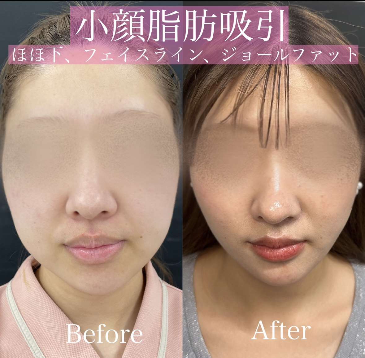 脂肪吸引の症例写真