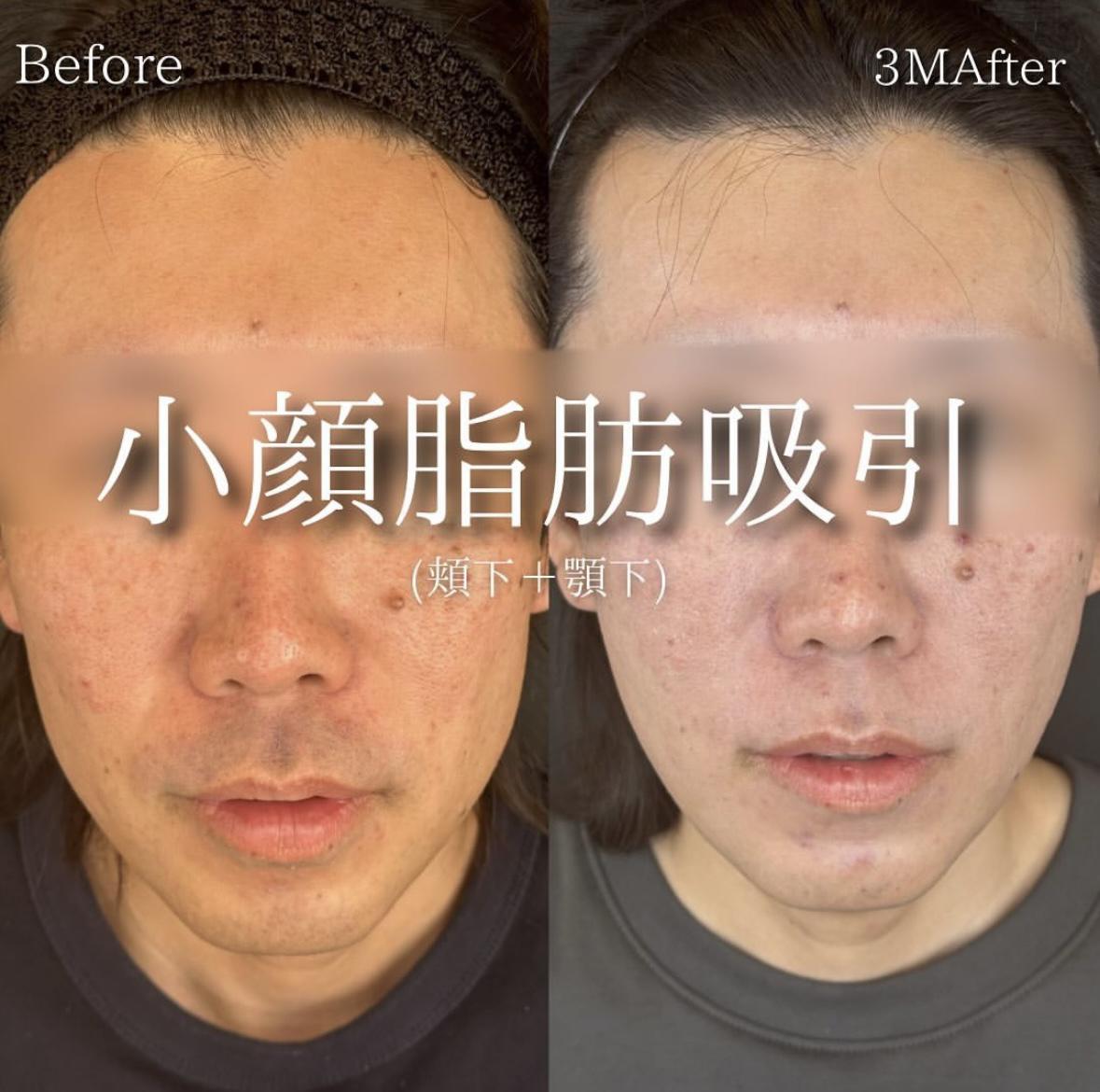 脂肪吸引の症例写真
