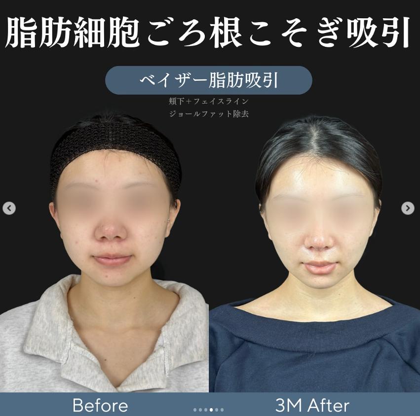 脂肪吸引の症例写真