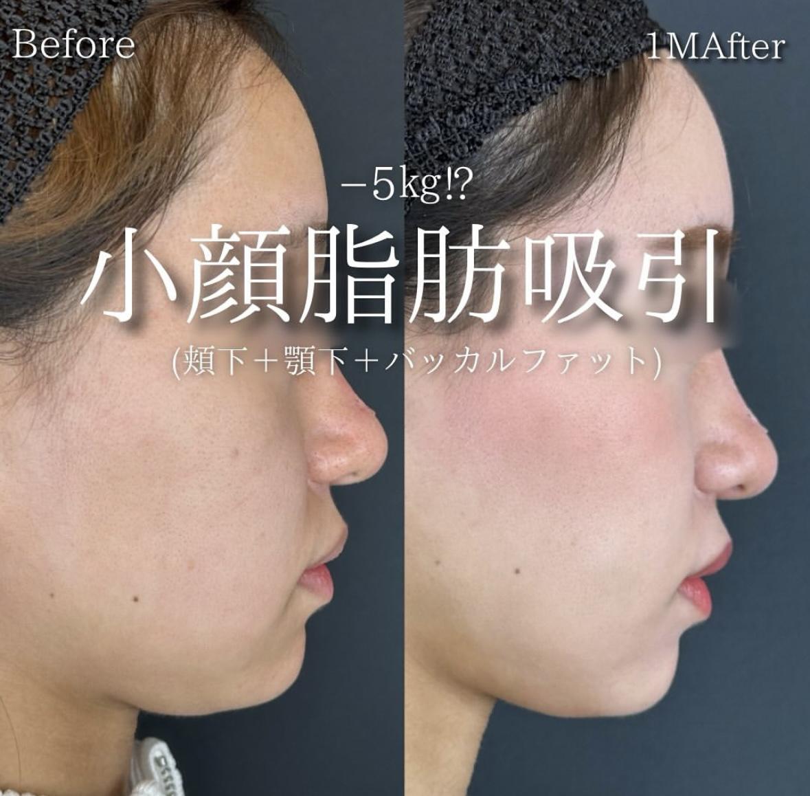 脂肪吸引の症例写真
