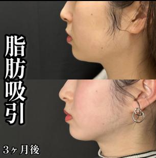 脂肪吸引の症例写真