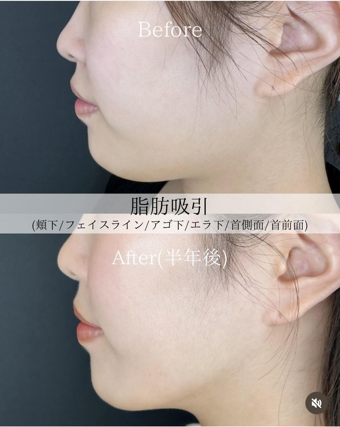 脂肪吸引の症例写真