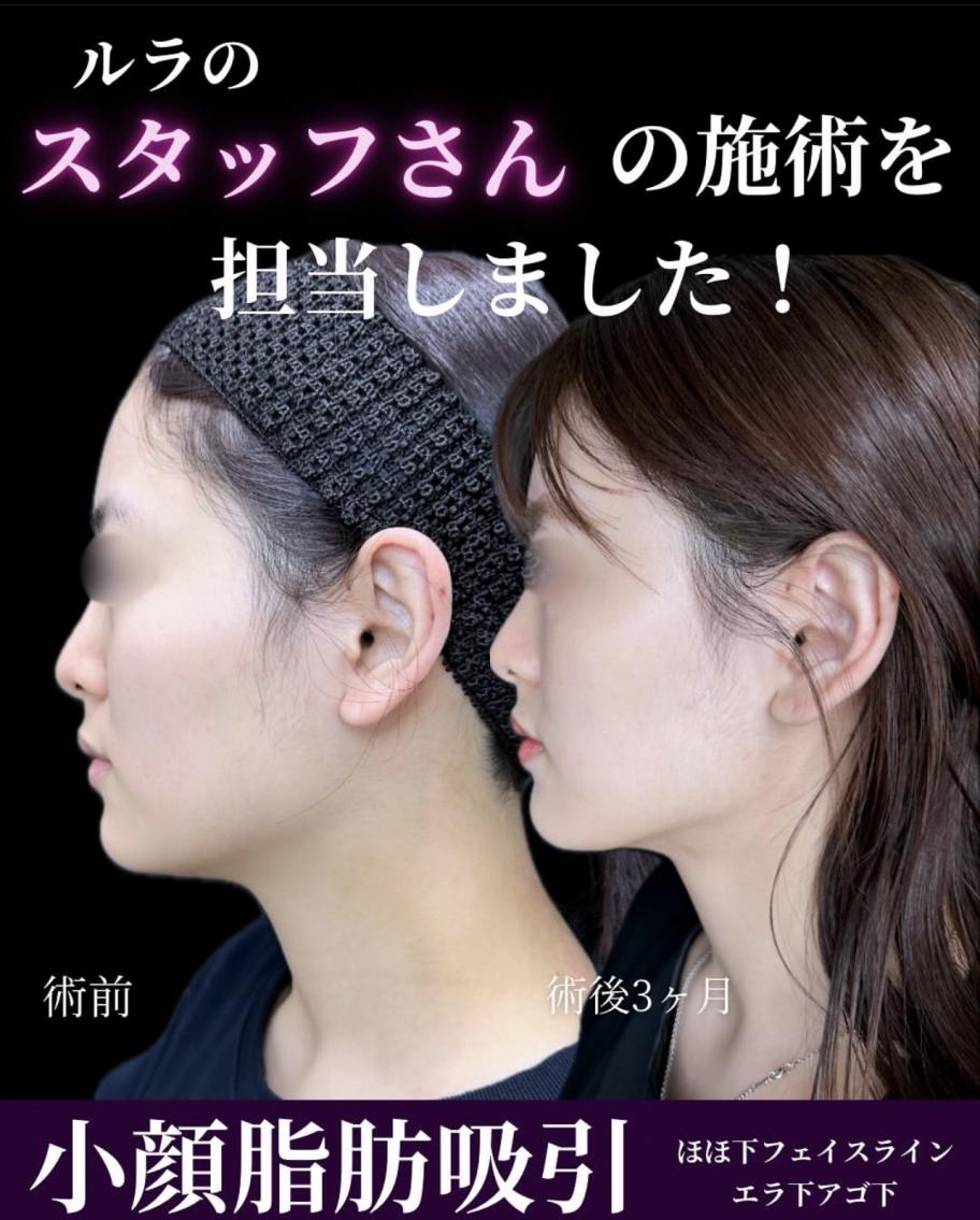 脂肪吸引の症例写真