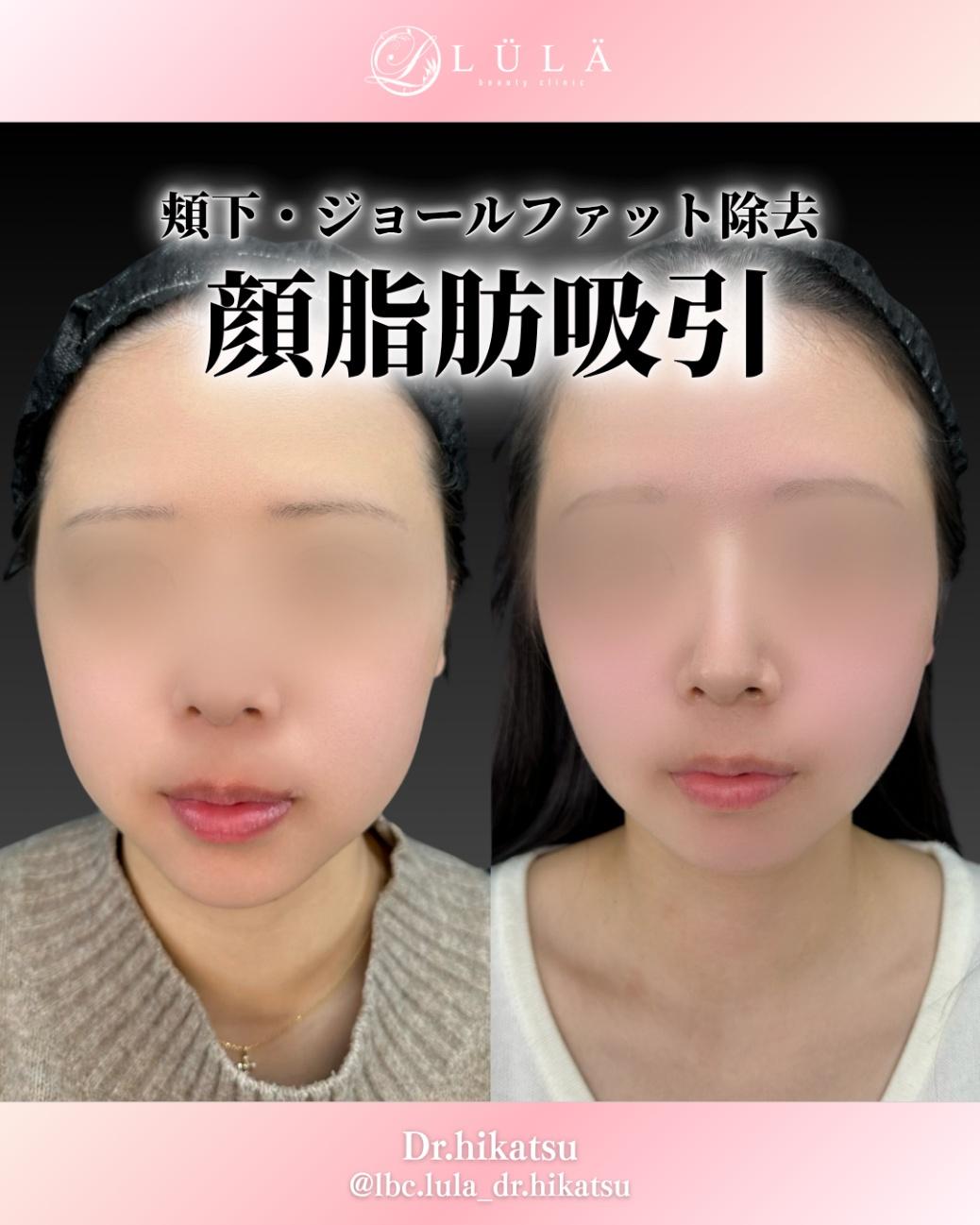 脂肪吸引の症例写真