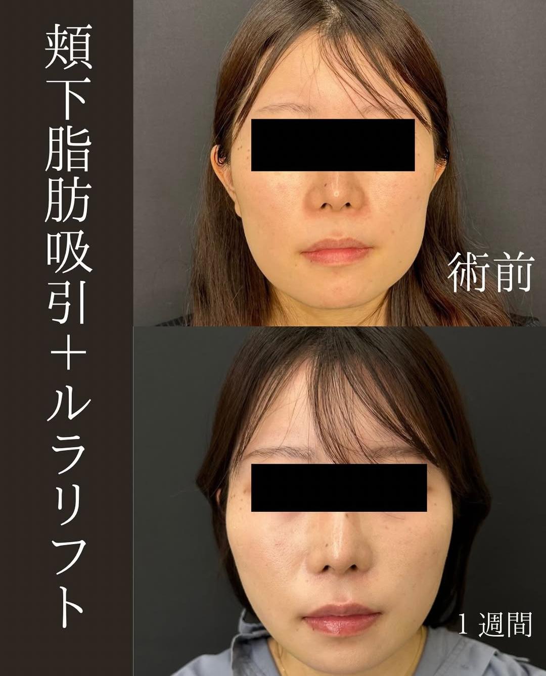 脂肪吸引の症例写真