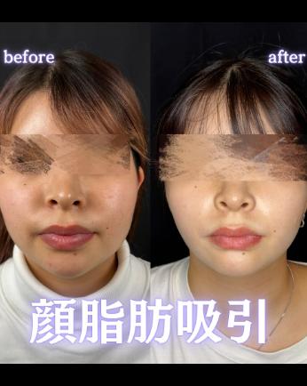 脂肪吸引の症例写真