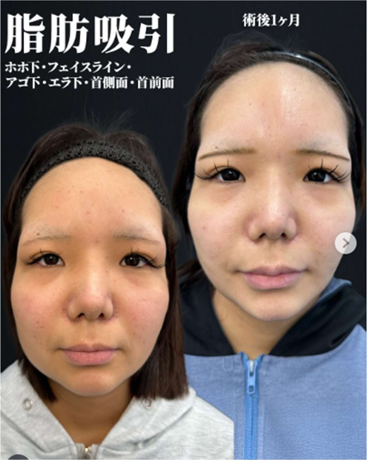 脂肪吸引の症例写真