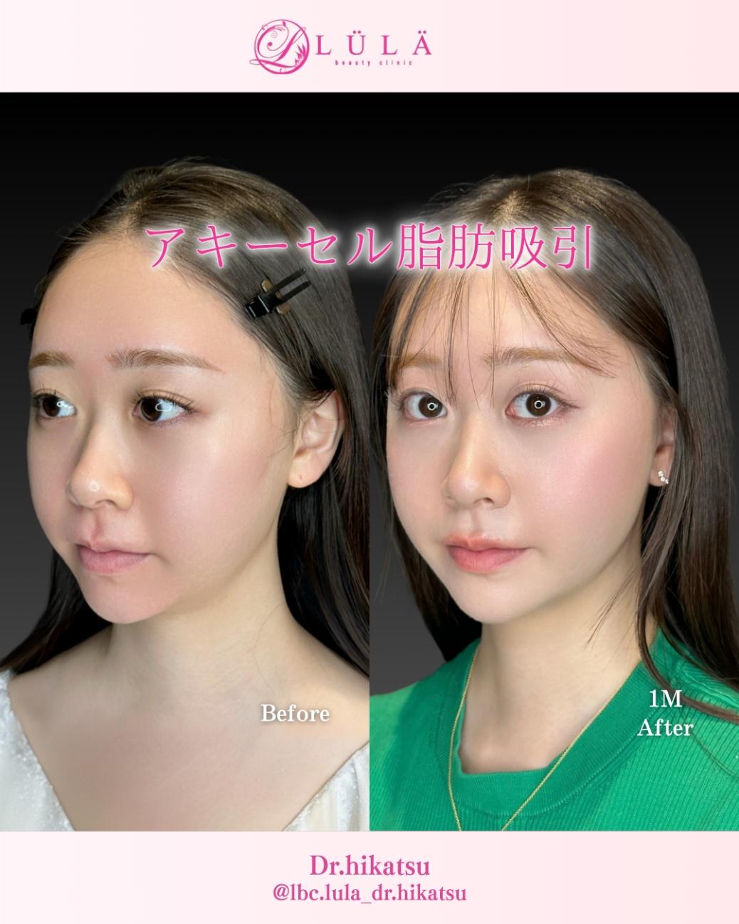 脂肪吸引の症例写真